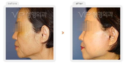 Face Lift - Wrinkle improvement surgery