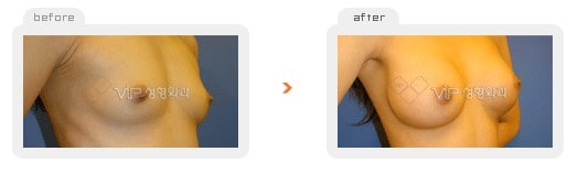 	Breast Surgery	 - Breast augmentation