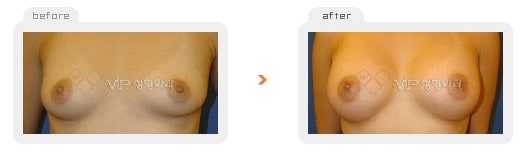 	Breast Surgery	 - Breast augmentation