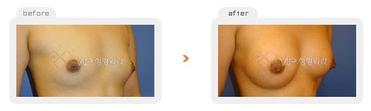 	Breast Surgery	 - Breast augmentation