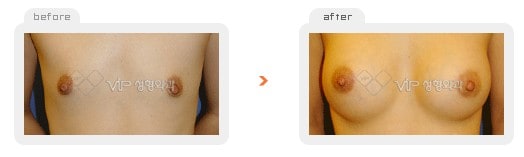 	Breast Surgery	 - Breast augmentation