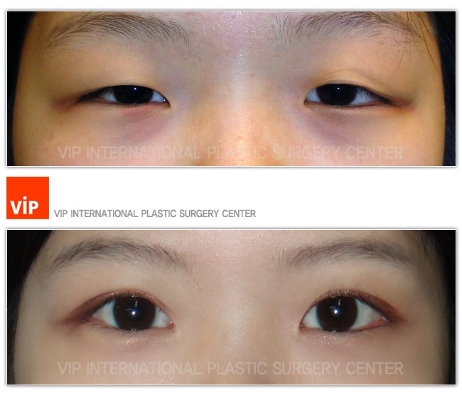 	Eye Surgery, Double Fold, Ptosis Correction	 - Ptosis correction