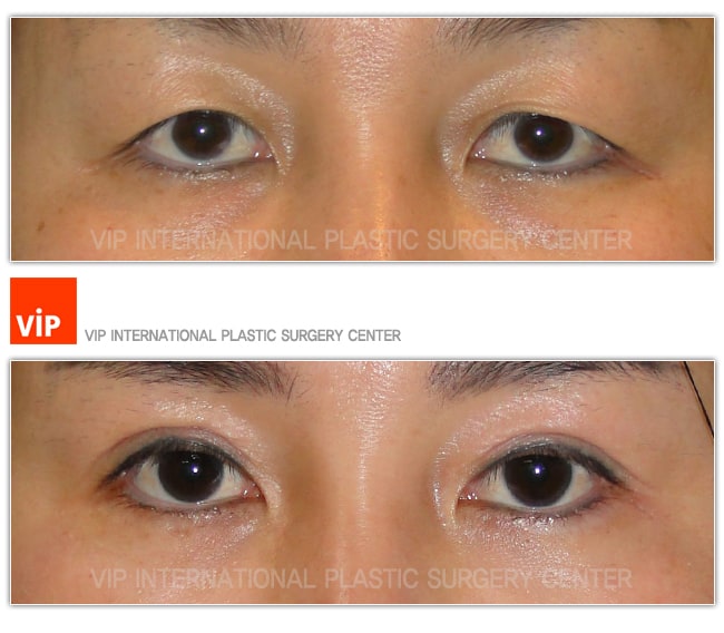 	Eye Surgery, Double Fold, Ptosis Correction	 - Ptosis Correction
