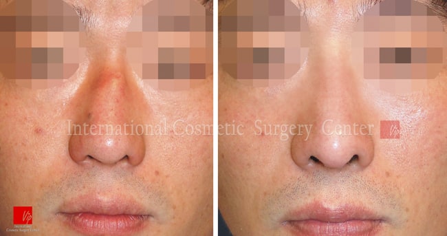 	Protruded Mouth Correction Rhinoplasty, Contracted Nose, Revision Rhinoplasty	 - 2nd Op. - Rib cartilage rhinoplasty