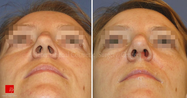 	Nose Surgery, Harmony-Rhinoplasty, Each Cases Nose	 - Septal deviation, humped nose correction
