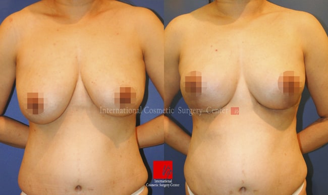 	Breast Surgery	 - Breast lift