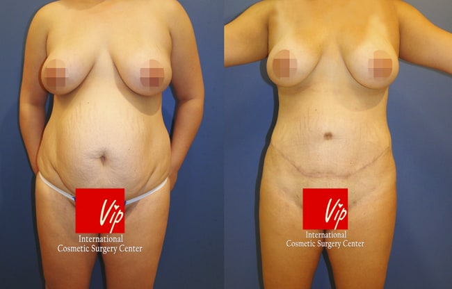 	Body Contouring	 - Abdominal surgery with liposuction