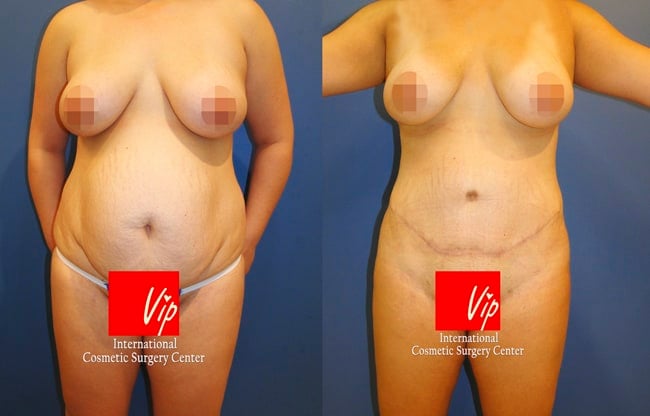 	Body Contouring	 - Abdominal surgery with liposuction