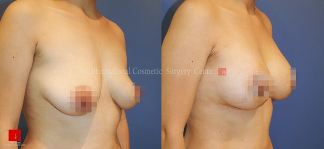 	Breast Surgery, Body Contouring	 - Breast lift & augmentation