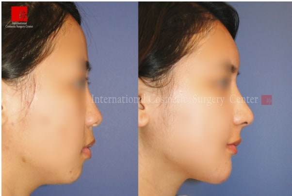 	Nose Surgery, Rib cartilage Rhinoplasty, Fat graft	 - Autologous Rhinoplasty and Fat graft