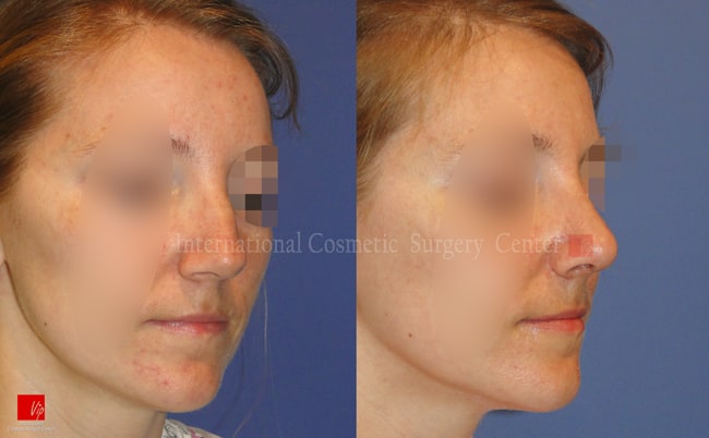 	Nose Surgery, Harmony-Rhinoplasty, Each Cases Nose	 - Septal deviation, humped nose correction