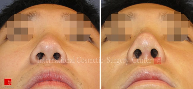	Nose Surgery, Harmony-Rhinoplasty, Each Cases Nose, Septal Deviation	 - Septal deviation
