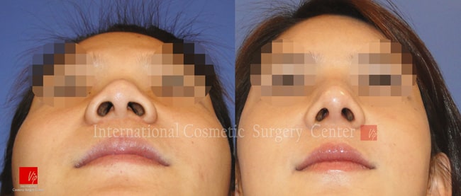 	Nose Surgery, Harmony-Rhinoplasty, Each Cases Nose	 - Harmony face surgery