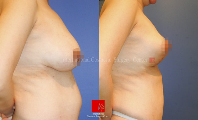 	Breast Surgery	 - Breast lift