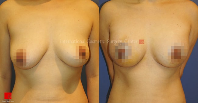 	Breast Surgery, Body Contouring	 - Breast lift & augmentation