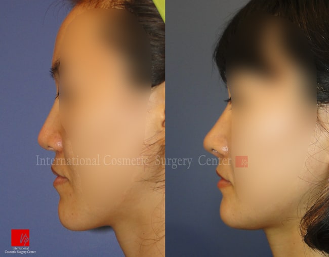 	Harmony-Rhinoplasty, Protruded Mouth Correction Rhinoplasty, Rib cartilage Rhinoplasty, Revision Rhinoplasty, Septal Deviation	 - Revision rhinoplasty using Rib cartilage