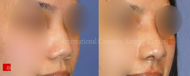 	Nose Surgery, Harmony-Rhinoplasty, Rib cartilage Rhinoplasty	 - Correction of protruded mouth with Harmony rhinoplasty