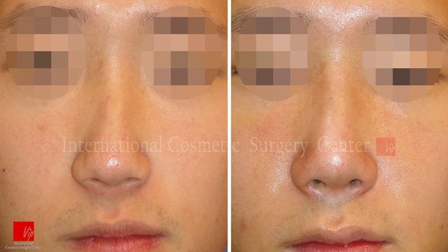 	Nose Surgery, Harmony-Rhinoplasty, Each Cases Nose, Septal Deviation	 - Septal deviation