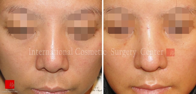 	Nose Surgery, Revision Rhinoplasty, Each Cases Nose	 - Remove foreign implant & autologous rhinoplasty