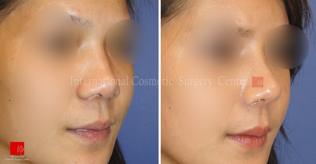 	Nose Surgery, Harmony-Rhinoplasty, Each Cases Nose	 - Harmony face surgery