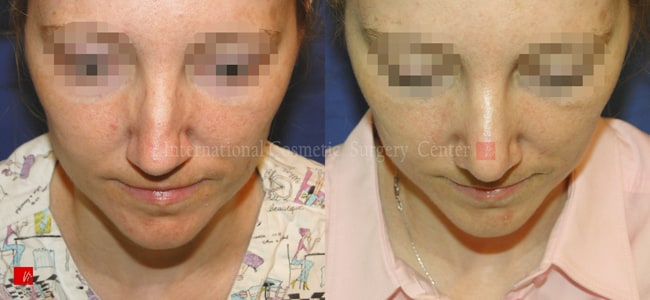 	Nose Surgery, Harmony-Rhinoplasty, Each Cases Nose	 - Septal deviation, humped nose correction