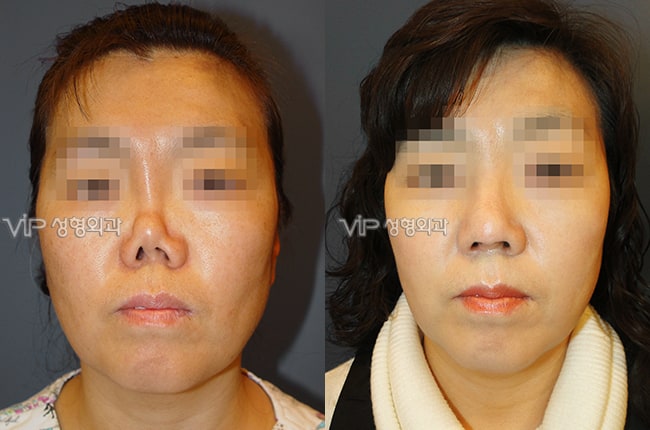 	Protruded Mouth Correction Rhinoplasty, Rib cartilage Rhinoplasty, Contracted Nose, Revision Rhinoplasty, Each Cases Nose	 - Revision rhinoplasty with Rib cartilage -Collapsed by silicone implant