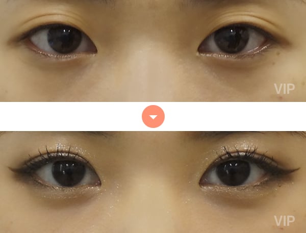 Eye Surgery - Double Eyelid Surgery