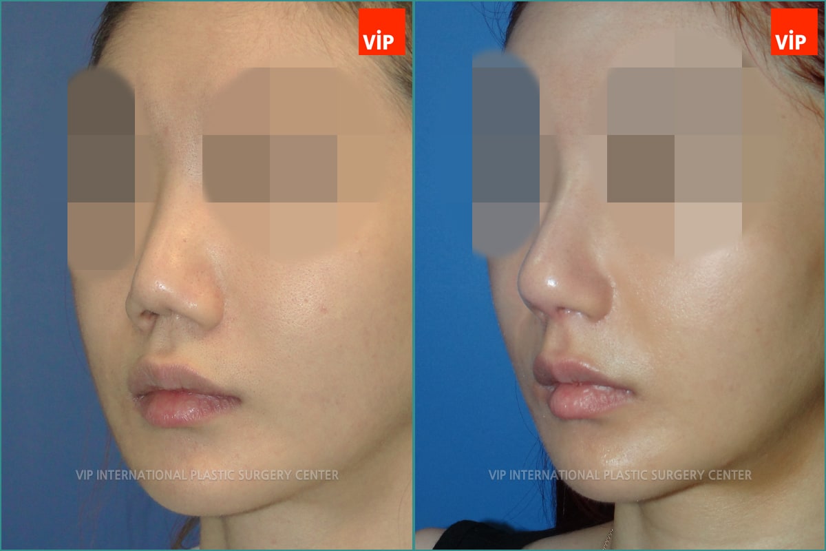 	Nose Surgery, Rib cartilage Rhinoplasty, Contracted Nose, Each Cases Nose	 - Rib cartilage Rhinoplasty