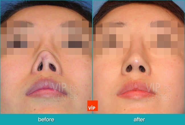 	Nose Surgery, Rib cartilage Rhinoplasty, Contracted Nose, Revision Rhinoplasty, Each Cases Nose	 - Reconstructed nose by rib cartilage rhinoplasty