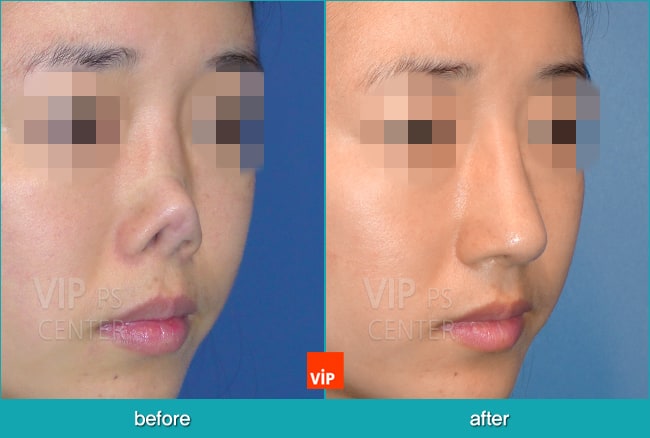 	Nose Surgery, Rib cartilage Rhinoplasty, Contracted Nose, Revision Rhinoplasty, Each Cases Nose	 - Reconstructed nose by rib cartilage rhinoplasty
