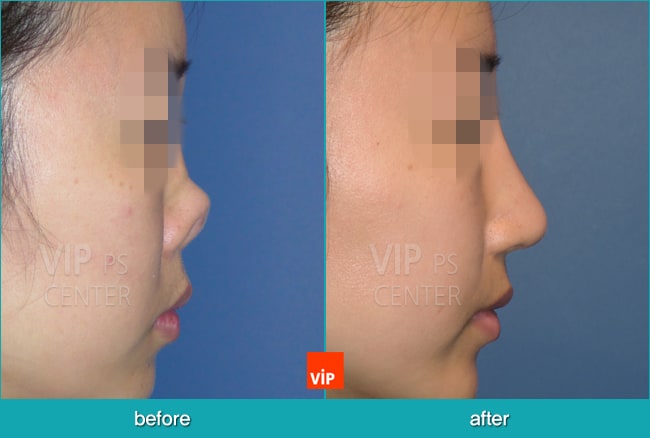 	Nose Surgery, Rib cartilage Rhinoplasty, Contracted Nose, Revision Rhinoplasty, Each Cases Nose	 - Reconstructed nose by rib cartilage rhinoplasty