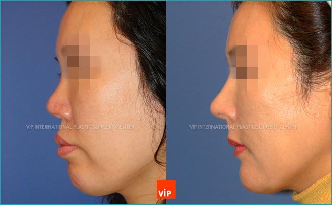 	Nose Surgery, Rib cartilage Rhinoplasty, Contracted Nose, Revision Rhinoplasty, Each Cases Nose	 - Rib Cartilage Rhinoplasty