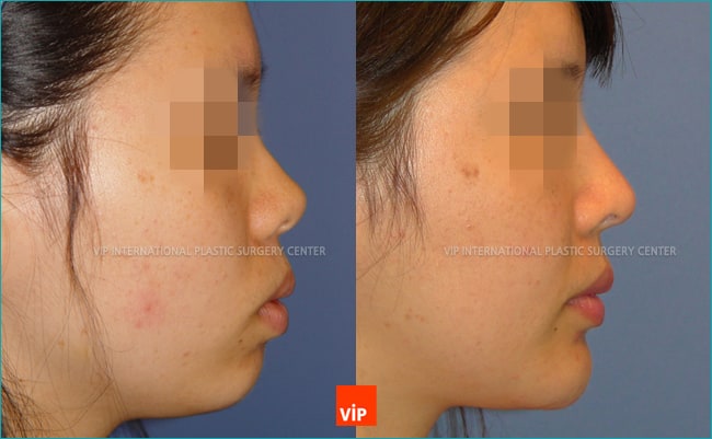 Nose Surgery, Facial Bone Surgery - Protruded Mouth Correction by Rhinoplasty, Genioplasty