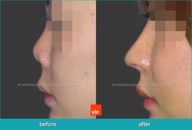 	Nose Surgery, Rib cartilage Rhinoplasty, Contracted Nose, Revision Rhinoplasty	 - Post infection contracted nose correction with rib cartilage rhinoplasty