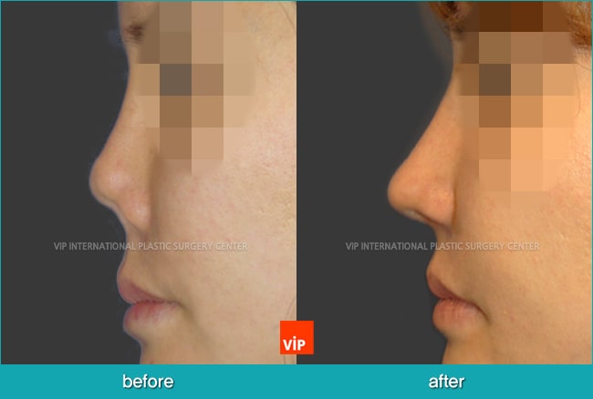 	Nose Surgery, Rib cartilage Rhinoplasty, Contracted Nose, Revision Rhinoplasty	 - Post infection contracted nose correction with rib cartilage rhinoplasty