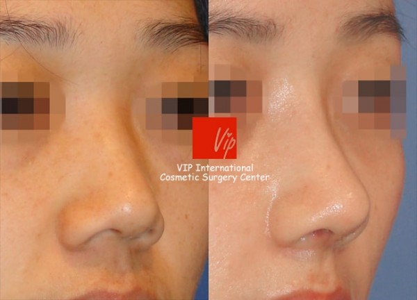 	Harmony-Rhinoplasty, Protruded Mouth Correction Rhinoplasty, Rib cartilage Rhinoplasty	 - Harmony rhinoplasty