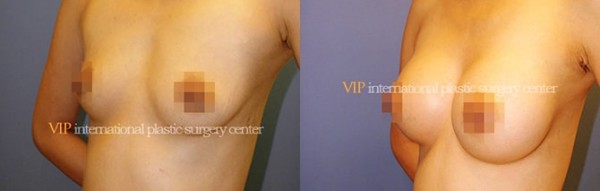 Breast Surgery - Breast surgery