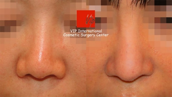 	Rib cartilage Rhinoplasty, Contracted Nose, Revision Rhinoplasty	 - Harmony rhinoplasty - Septal deviation correction+balanced profile view