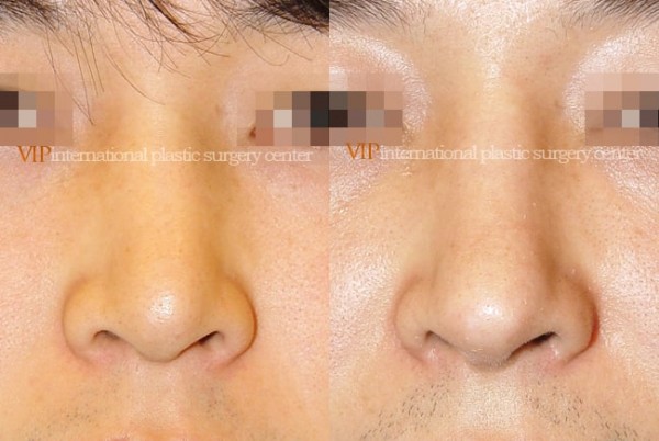 Nose Surgery - Septal deviation correction
