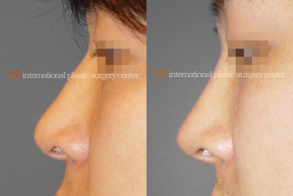 Nose Surgery - Septal deviation correction