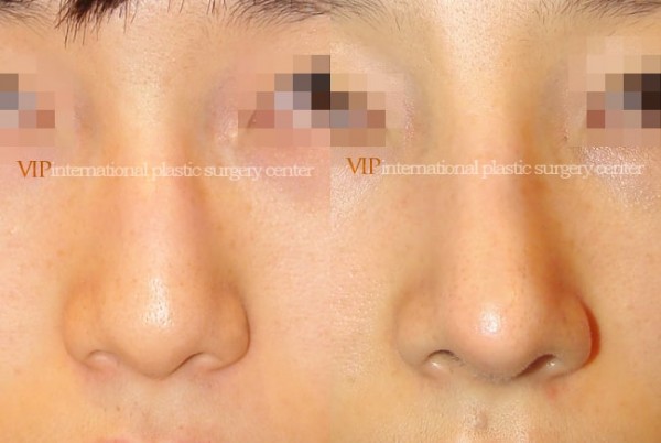 Nose Surgery - Nose bridge correction