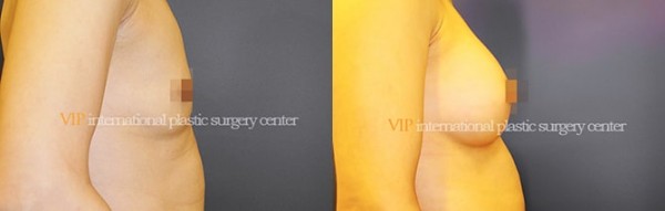 Breast Surgery - Breast surgery
