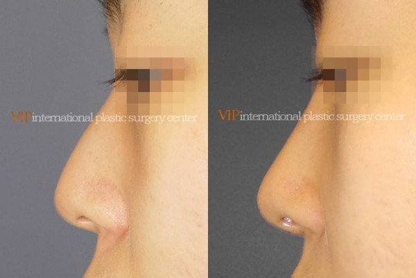 Nose Surgery - Nose bridge correction