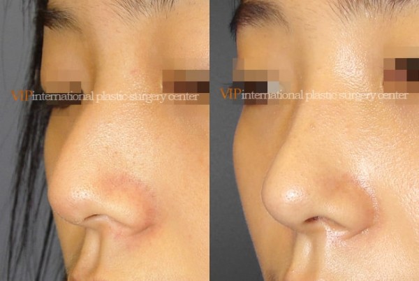 Nose Surgery - Nose bridge correction