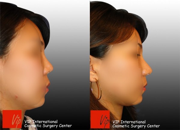 	Harmony-Rhinoplasty, Rib cartilage Rhinoplasty, Revision Rhinoplasty	 - Upturned nose due to silicone - Revision surgery