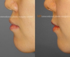 Protruded mouth correction