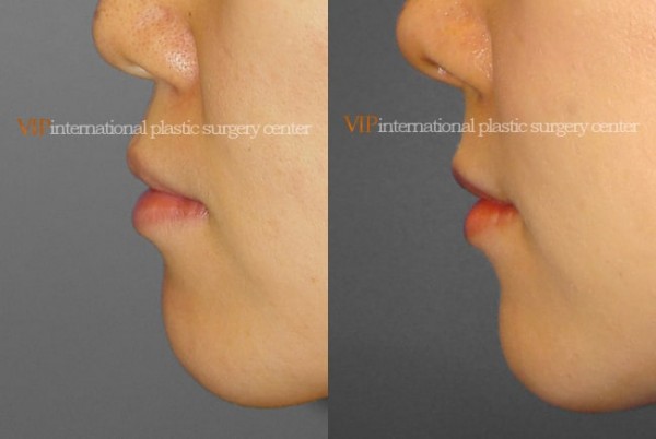	Nose Surgery, Protruded Mouth Correction Rhinoplasty	 - Protruded mouth correction