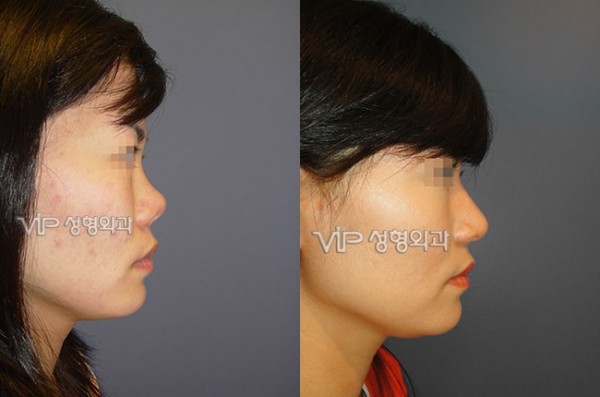 	Rib cartilage Rhinoplasty, Contracted Nose, Revision Rhinoplasty	 - Upturned nose due to silicone contraction - Revision with Rib cartilage