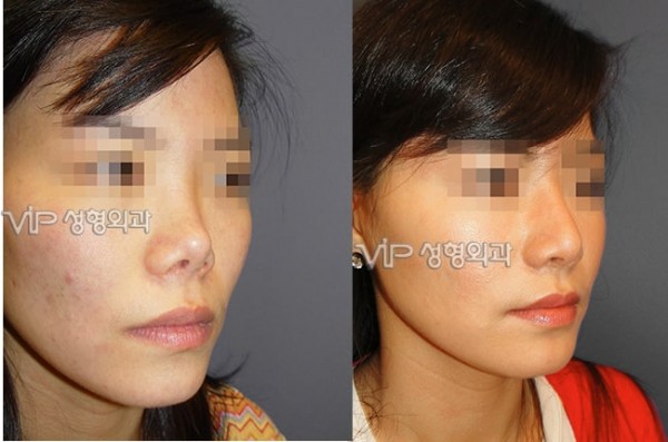 	Rib cartilage Rhinoplasty, Contracted Nose, Revision Rhinoplasty	 - Upturned nose due to silicone contraction - Revision with Rib cartilage