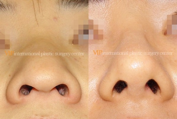 Nose Surgery - Long nose with Depressed columella